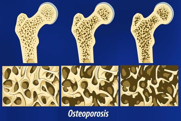 98280150_osteoporoz